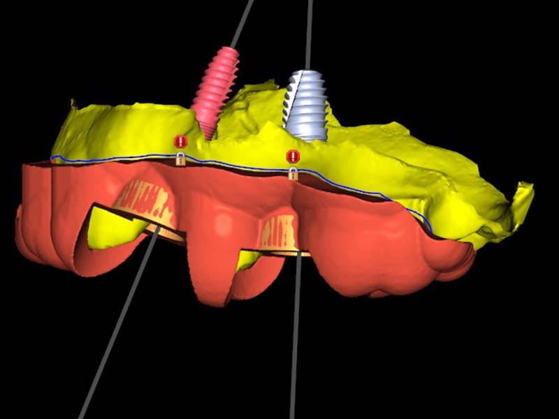 Cerrahi guide ve implant planlama yazılımı görüntüsü