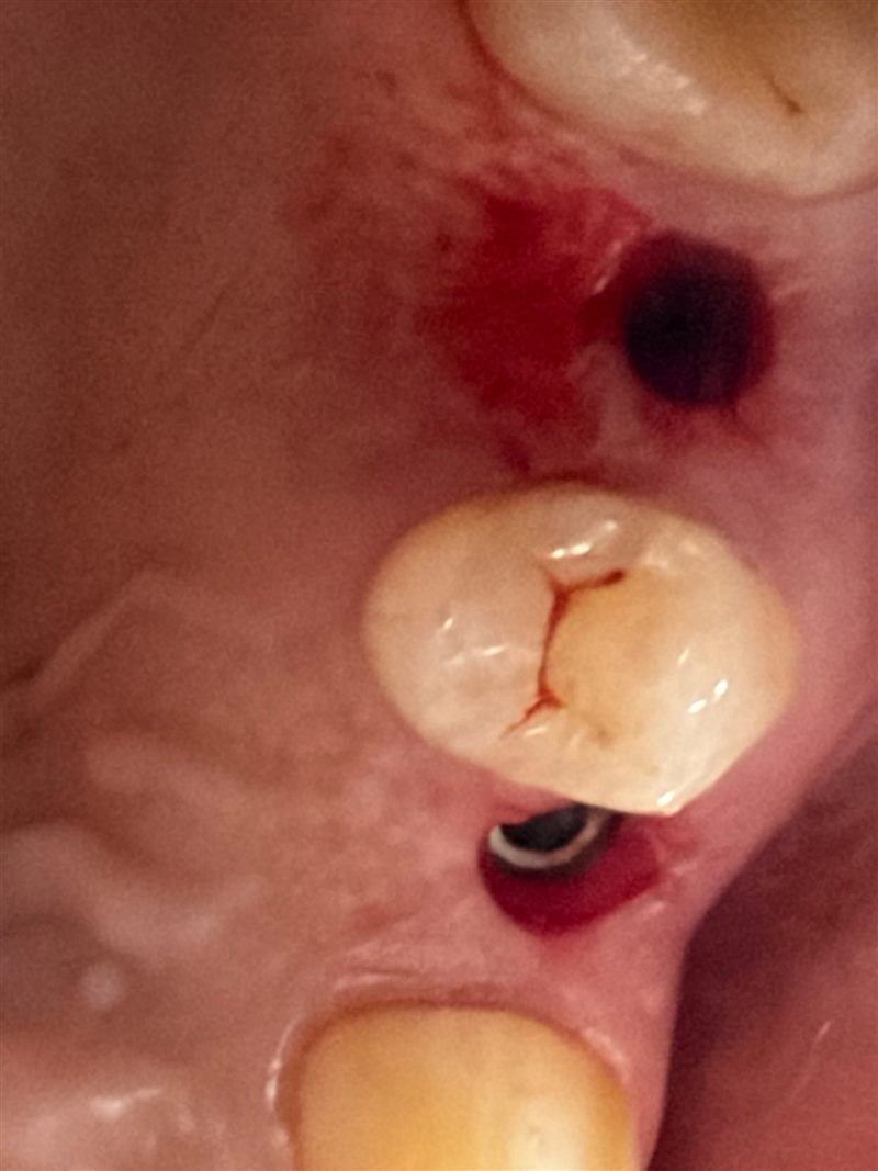 Guide ile açılmış implant yuvaları
