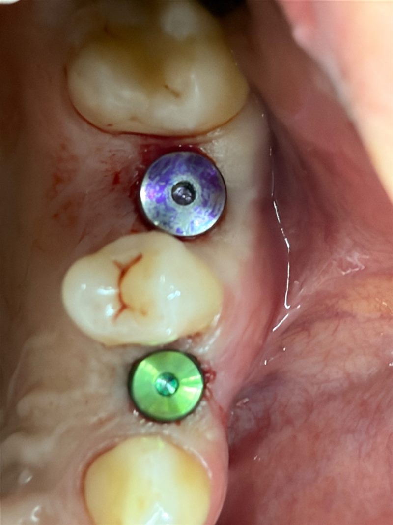 Yerleştirilmiş iki implant ve iyileşme başlıkları